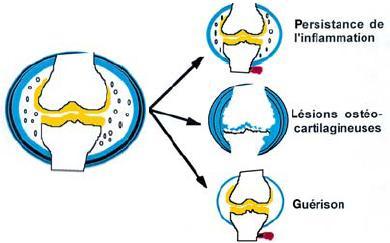 La polyarthrite rhumatoide - Le blog de Martine et Cie